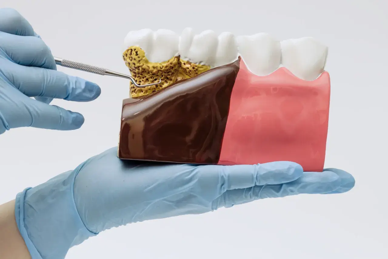 Model szczęki z widocznym spuchniętym dziąsłem i kamieniem nazębnym, badany narzędziem dentystycznym.