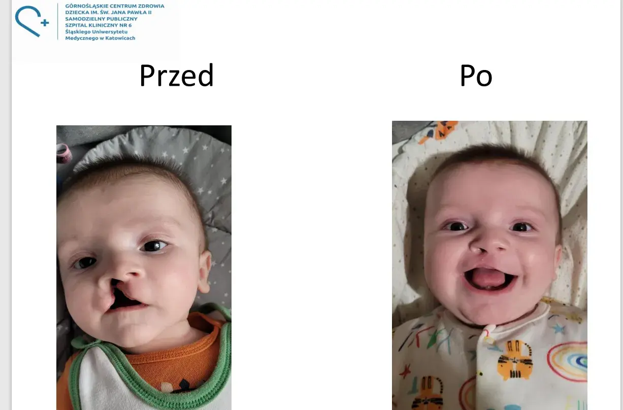 Uśmiechnięty chłopiec po korekcie zajęczej wargi. Po lewej widać szew, po prawej uśmiech.