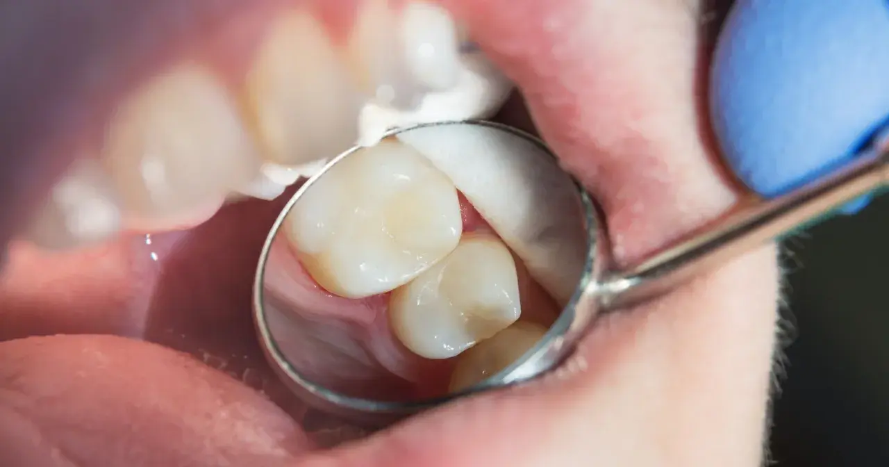 Dentysta bada zęby, szukając próchnicy ukrytej. Widoczne są zęby, lusterko dentystyczne i wata.
