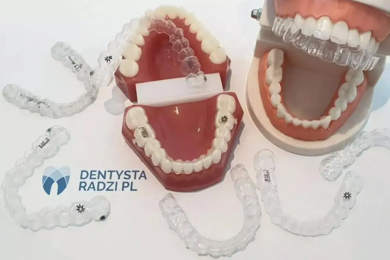 Nakładki czy aparat? Cena, komfort, skuteczność co wybrać?