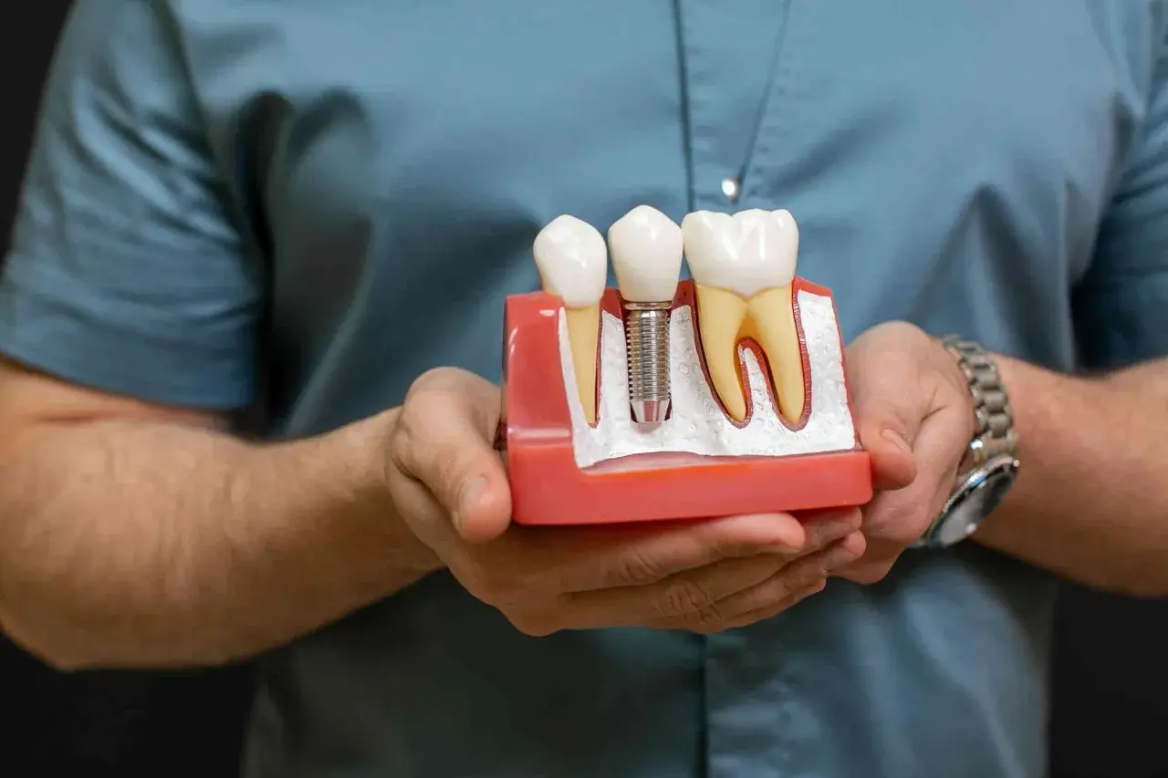 Model szczęki pokazuje, jak działa implant zęba, zastępując korzeń naturalnego zęba.