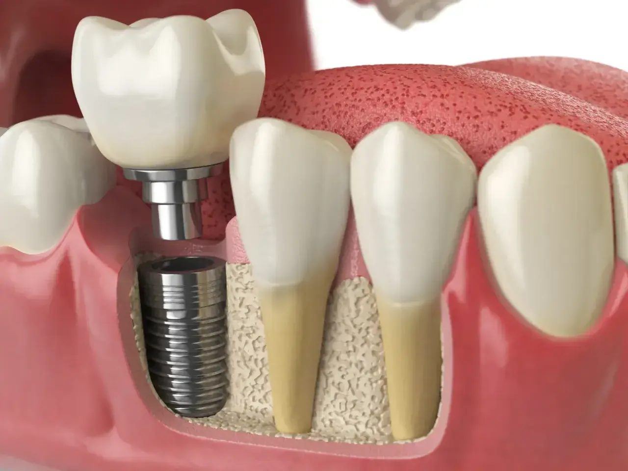 Implant zębowy w trakcie wszczepiania. Szukasz najtańszych implantów zębowych w Polsce? To rozwiązanie dla Ciebie.