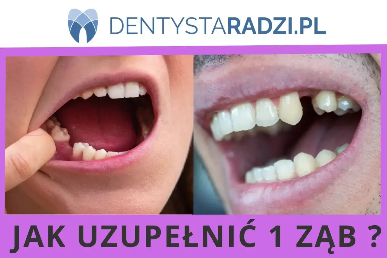 Dwa zbliżenia ust pokazujące braki w uzębieniu. Po lewej stronie widać palec wskazujący na brakujący ząb. Po prawej stronie widoczny jest brakujący ząb. Temat: hipodoncja.
