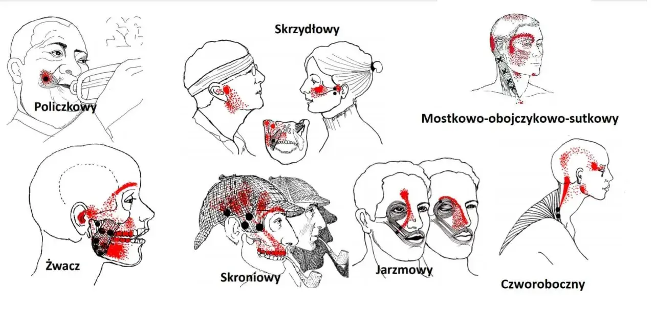 Ilustracje pokazują punkty bólu związane z różnymi typami bólu głowy, które mogą być mylone z objawami nowotworu stawu skroniowo-żuchwowego.