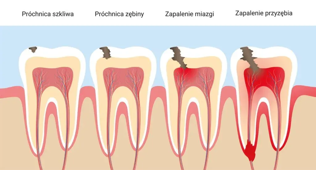 Ząb boli? Sprawdź, czy infekcja nie zagraża całemu organizmowi.