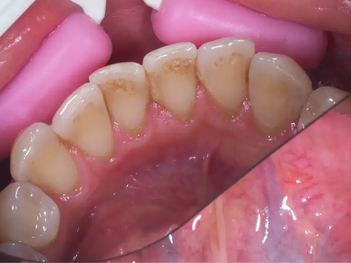 Zęby z przebarwieniami, jeden z nich wygląda jak czarny ząb. Widoczne różowe separatory dentystyczne.