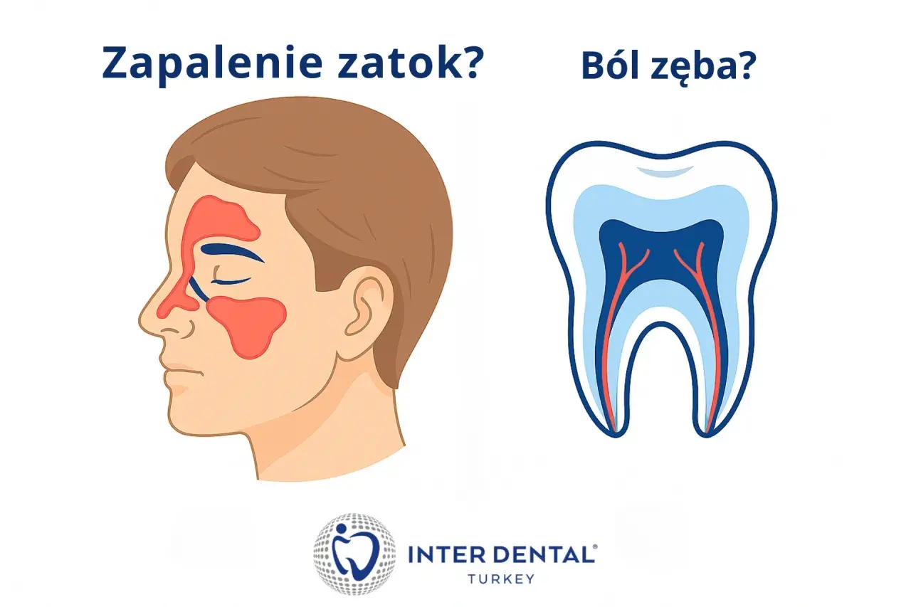 Zapalenie zatok czy tragiczny ból zęba? Ilustracja porównuje objawy zapalenia zatok z przekrojem zęba, sugerując, że oba mogą być przyczyną bólu.