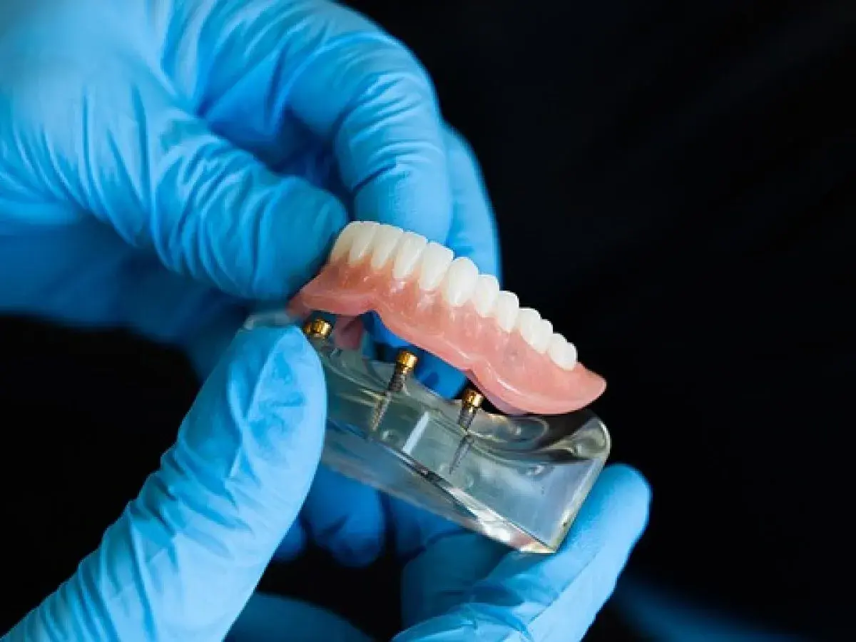 Ręce w niebieskich rękawiczkach trzymają model szczęki z implantami i cienkie protezy zębowe.