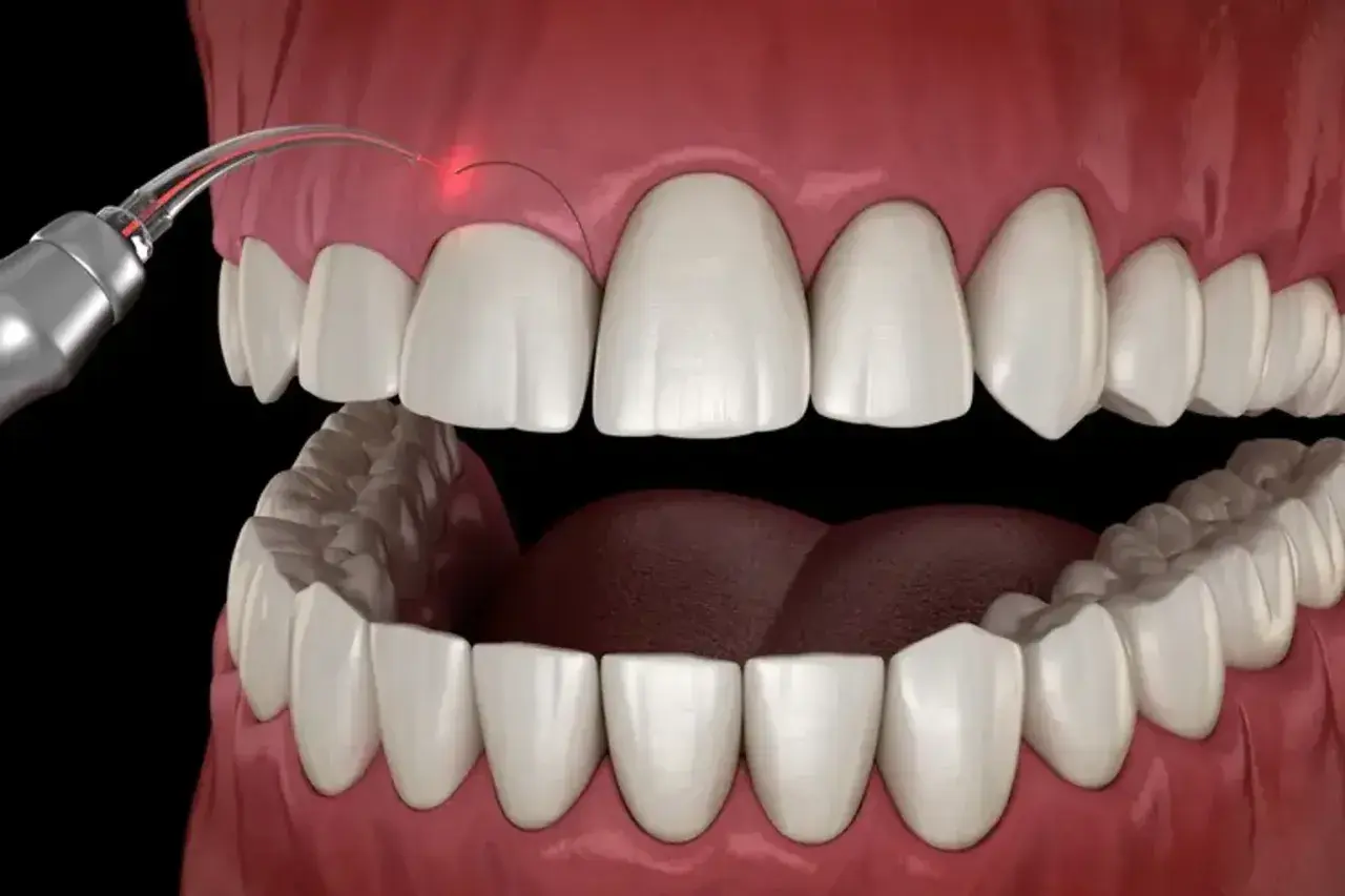 Zabieg gingiwektomii laserem. Precyzyjne modelowanie dziąseł dla pięknego uśmiechu.