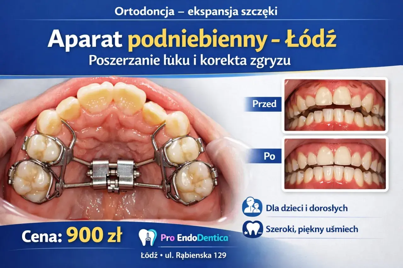 Aparat podniebienny w trakcie leczenia ortodontycznego. Zdjęcia "przed" i "po" pokazują korektę zgryzu.