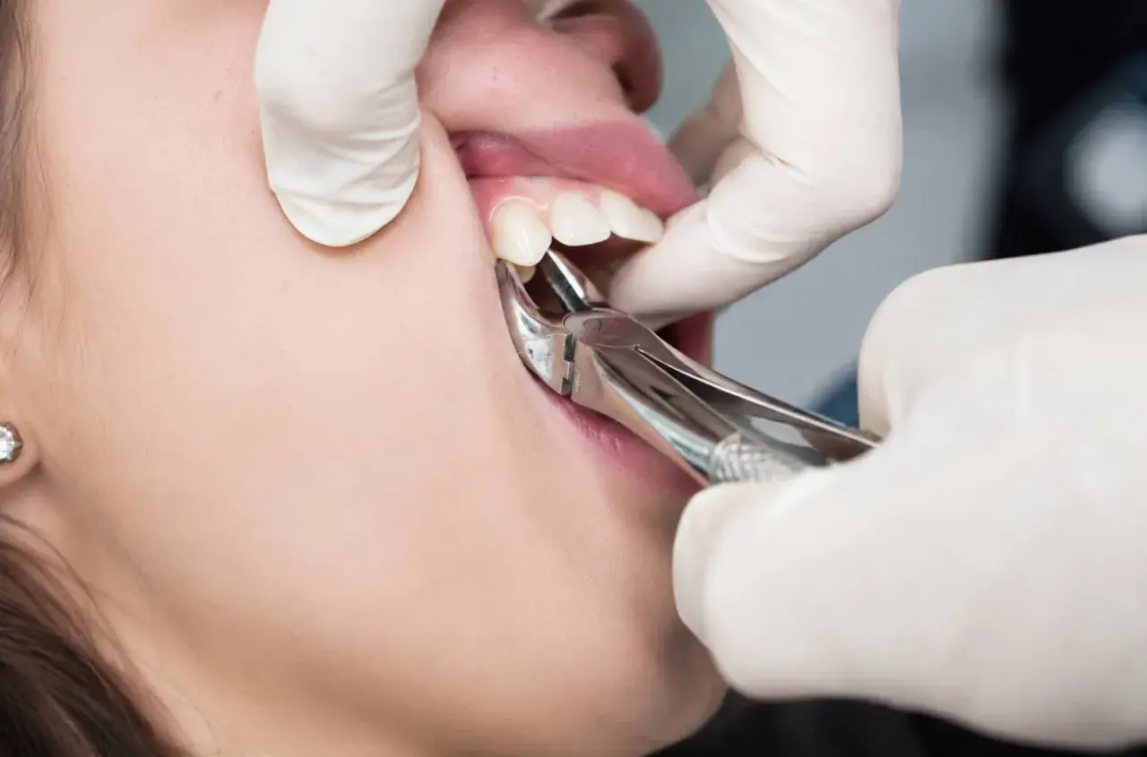 Dentysta wyrywa ząb kleszczami. Czy wyrywanie zęba boli? To zależy od znieczulenia i indywidualnego progu bólu.