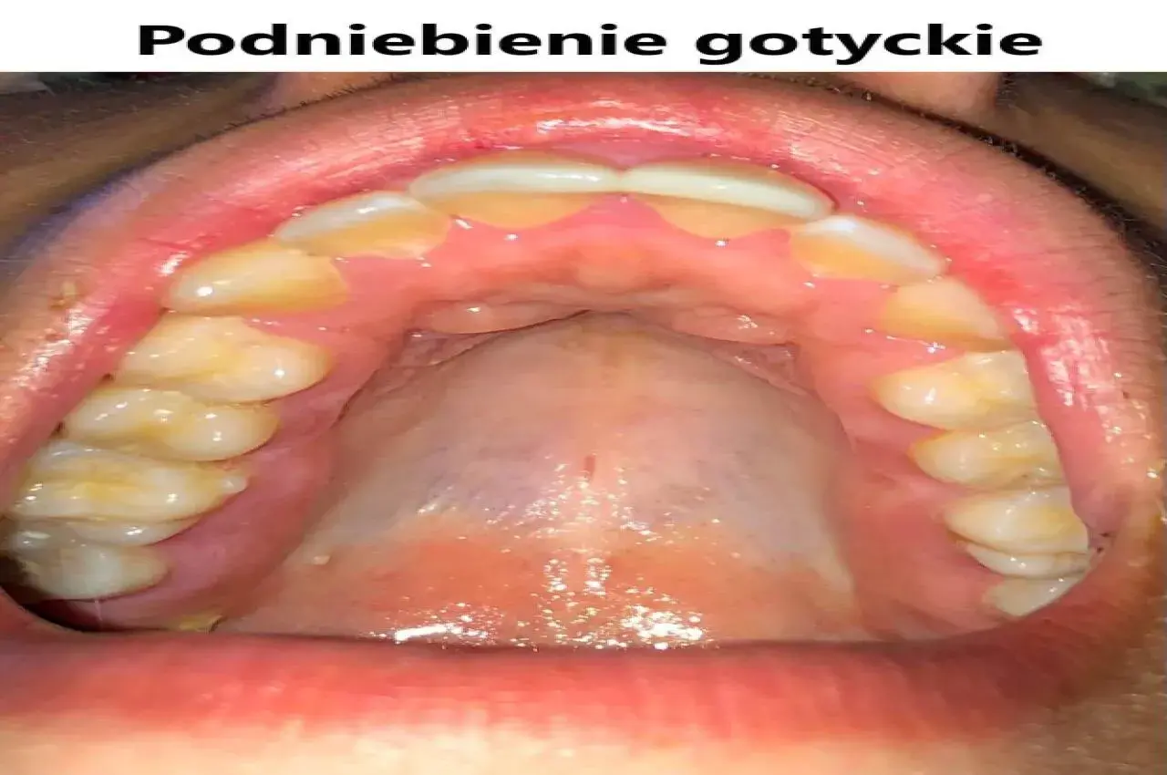 Widok jamy ustnej z zębami i podniebieniem. Charakterystyczne, wysokie podniebienie gotyckie, z widocznymi zębami trzonowymi i przedtrzonowymi.