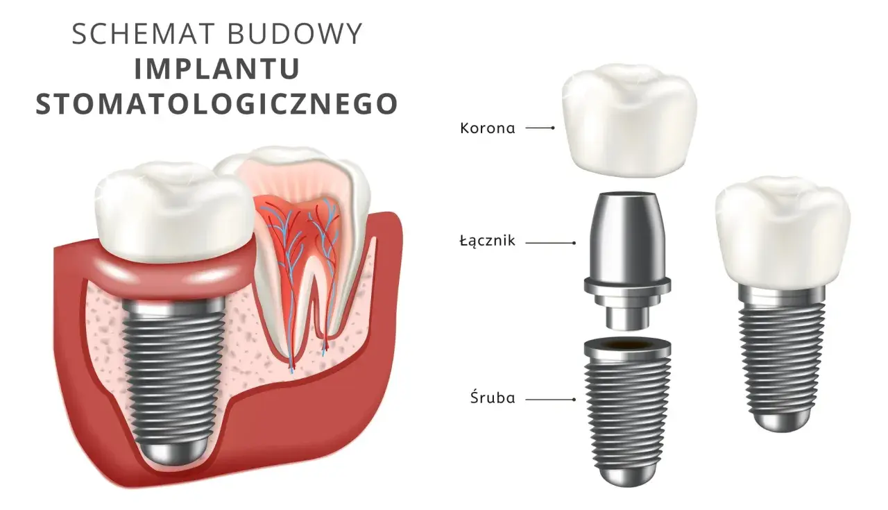 Schemat budowy implantu stomatologicznego. Dowiedz się, ile kosztuje zrobienie zębów i jakie są jego elementy: śruba, łącznik i korona.