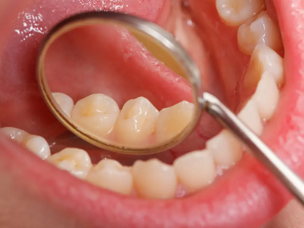 Widok jamy ustnej z lusterkiem dentystycznym, uwidaczniającym białe plamy na zębach.