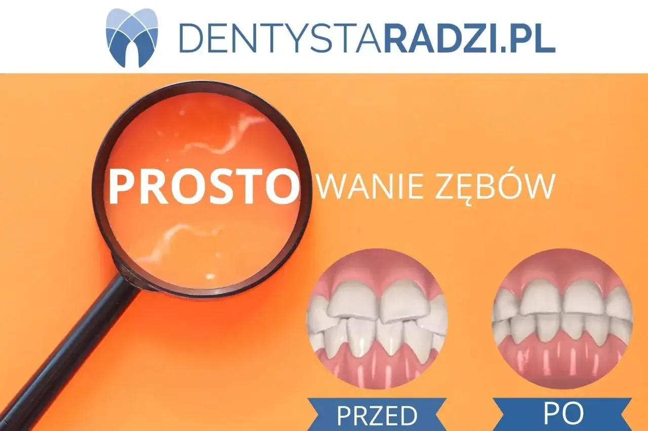 Przed i po: proste zęby dzięki licówkom. Zobacz, jak licówki na krzywe zęby zmieniają uśmiech.