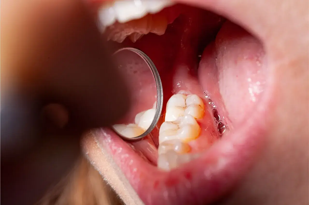 Widok jamy ustnej z widocznymi zębami i lustrem dentystycznym. Na zębach widoczne są oznaki demineralizacji szkliwa, co może prowadzić do próchnicy.