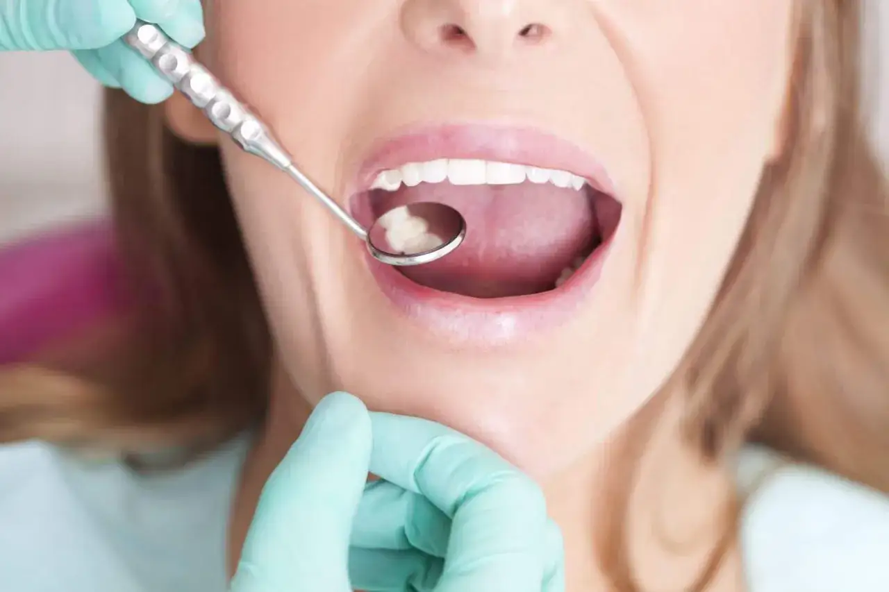 Usta kobiety otwarte, dentysta w rękawiczce bada ząb lusterkiem. Widoczne wypełnienie po borowaniu.
