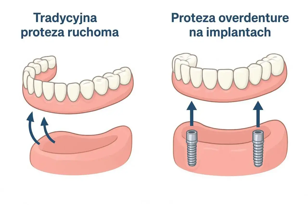 Porównanie tradycyjnej protezy ruchomej z protezą overdenture na implantach. Proteza overdenture zapewnia stabilność dzięki mocowaniu na implantach.