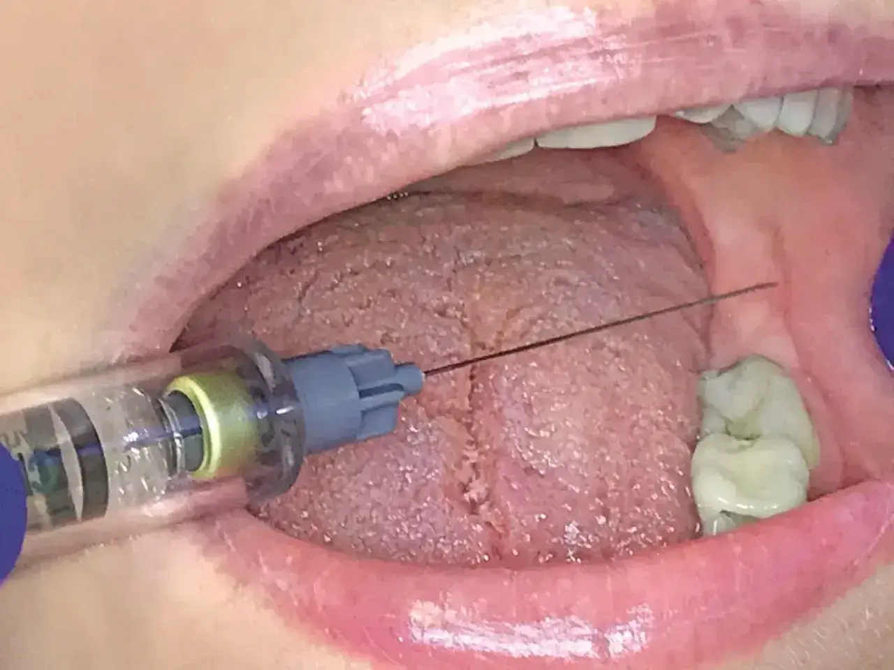 Znieczulenie przed zabiegiem implantacji zęba. Czy implant zęba boli? Zastrzyk w jamie ustnej.