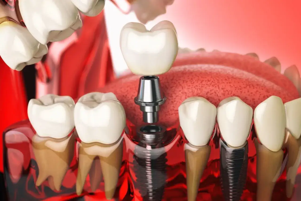 Model szczęki z implantem zęba. Czy implant zęba boli? Nowoczesna stomatologia oferuje bezbolesne zabiegi.