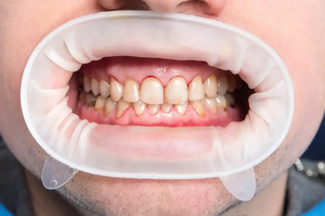 Usta z rozwierakiem dentystycznym, widoczne zęby z przebarwieniami i zaczerwienionymi dziąsłami, wskazujące na demineralizację szkliwa.