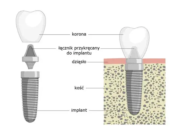 implant zęba schemat budowa