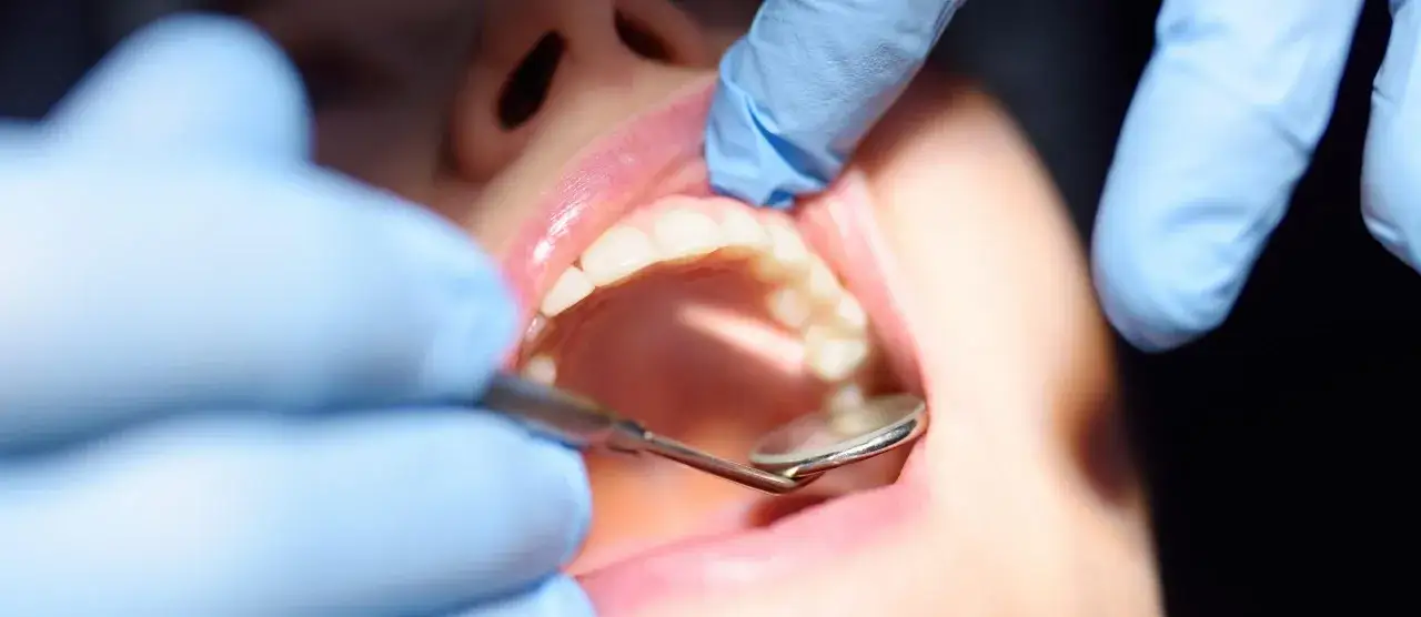 Dentysta bada zęby, szukając oznak próchnicy wtórnej. Widoczne są usta pacjenta i narzędzia stomatologiczne.