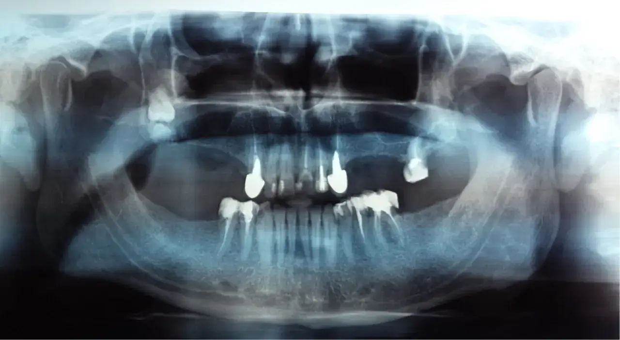 RTG szczęki z widocznymi implantami i zębami. Zębiak widoczny w dolnej szczęce.