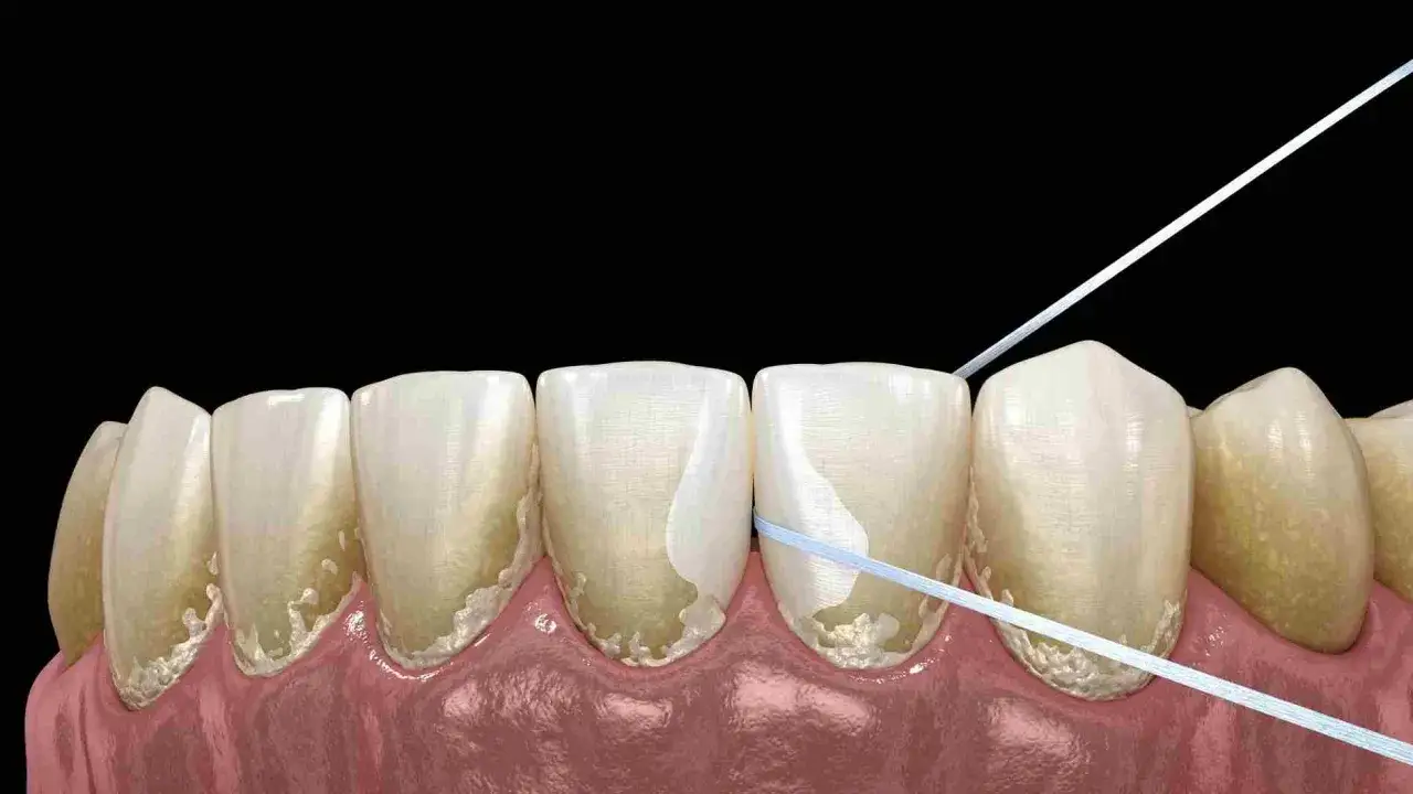 Nić dentystyczna pomaga w remineralizacji szkliwa, usuwając osad i zapobiegając próchnicy.