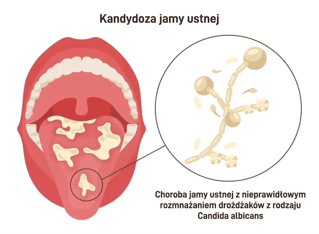 Ilustracja przedstawia jamę ustną z białymi nalotami na języku i podniebieniu, wskazującymi na grzybicę jamy ustnej. Obok powiększony obraz drożdżaków Candida albicans.