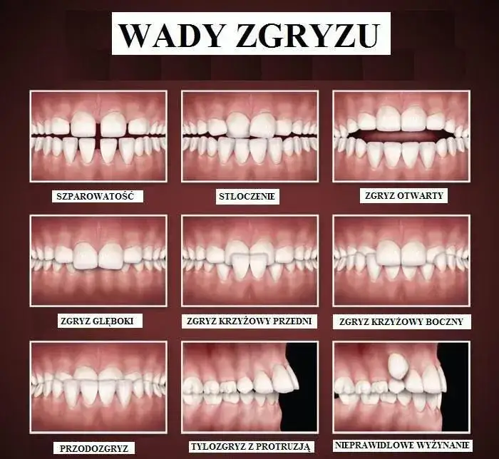 rodzaje wad zgryzu schematy