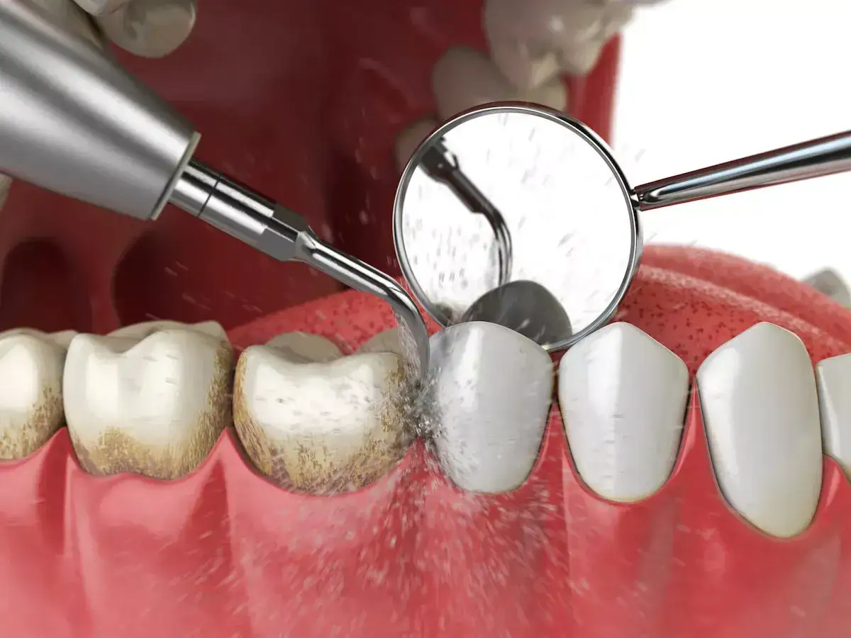 Profesjonalne odkamienianie zębów. Dentysta usuwa kamień ultradźwiękami, widoczne są zęby i narzędzia stomatologiczne.