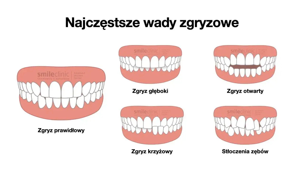 Zgryz prawidłowy – idealne ułożenie zębów, w przeciwieństwie do wad zgryzu: głębokiego, otwartego, krzyżowego i stłoczeń.