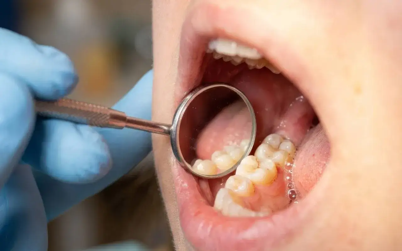 Dentysta bada zęby, szukając oznak próchnicy. Widać odbicie zębów w lusterku dentystycznym.
