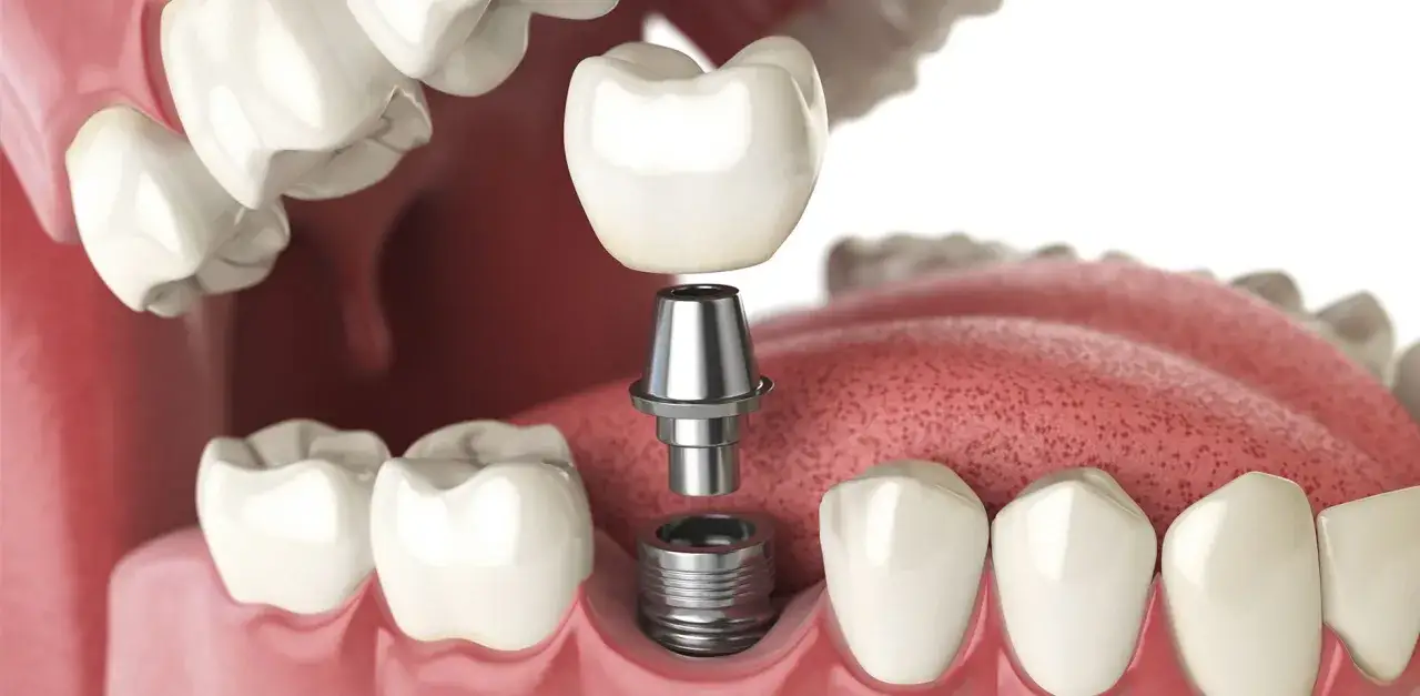 Model zęba z elementami do montażu: implant, łącznik i korona. Nowoczesne rozwiązanie dla pięknego uśmiechu.
