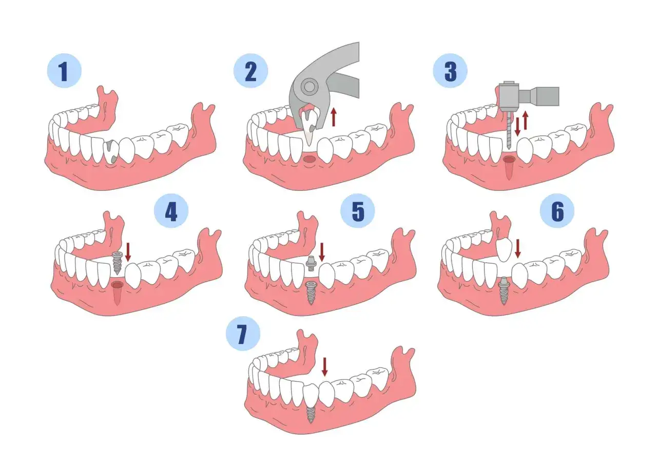 Ilustracja pokazuje etapy wszczepienia implantu zębowego: od ekstrakcji zęba, przez przygotowanie miejsca, po osadzenie implantu i korony.