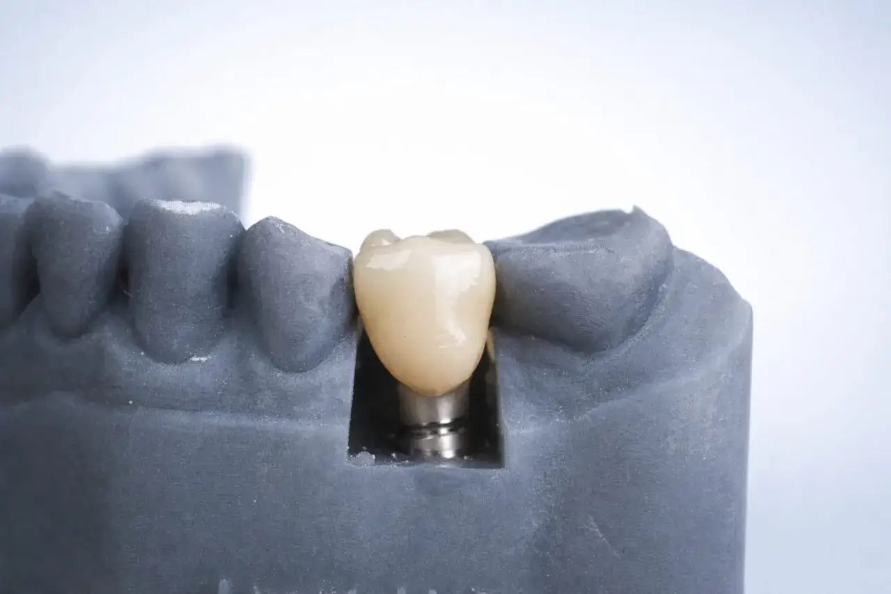Model szczęki z implantem zębowym. Pozwala ocenić koszt implantu zęba i jego estetykę.