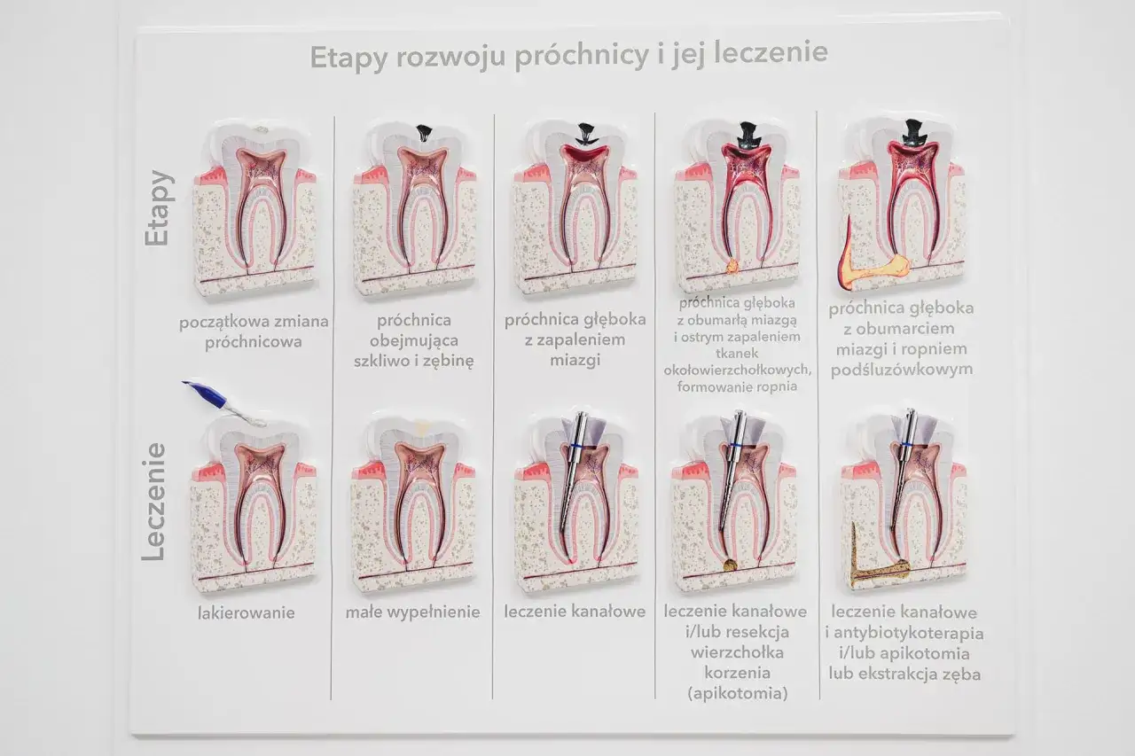 Schemat etapów rozwoju próchnicy i jej leczenie: od początkowej zmiany do ekstrakcji zęba.