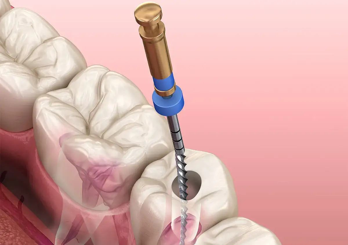 Ząb z ropą wymaga leczenia kanałowego. Wiertło stomatologiczne usuwa zainfekowaną tkankę. Jaki antybiotyk na ząb z ropą? Zapytaj dentystę.