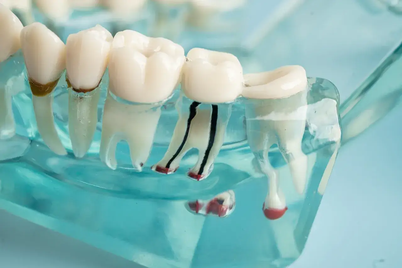 Model zębów pokazuje, jak wygląda endodoncja: leczenie kanałowe ratujące ząb przed ekstrakcją.