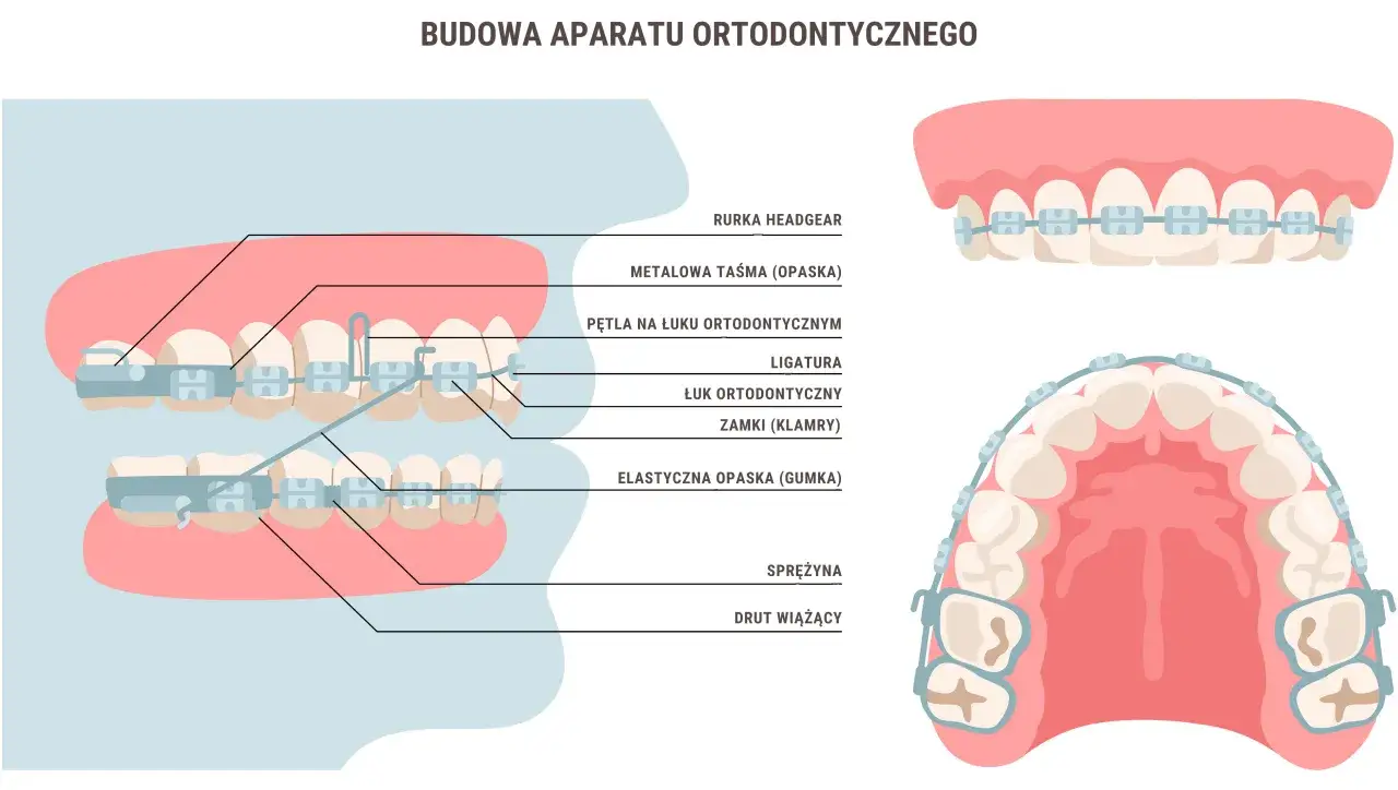 aparat ortodontyczny mechanizm działania na zęby i kości