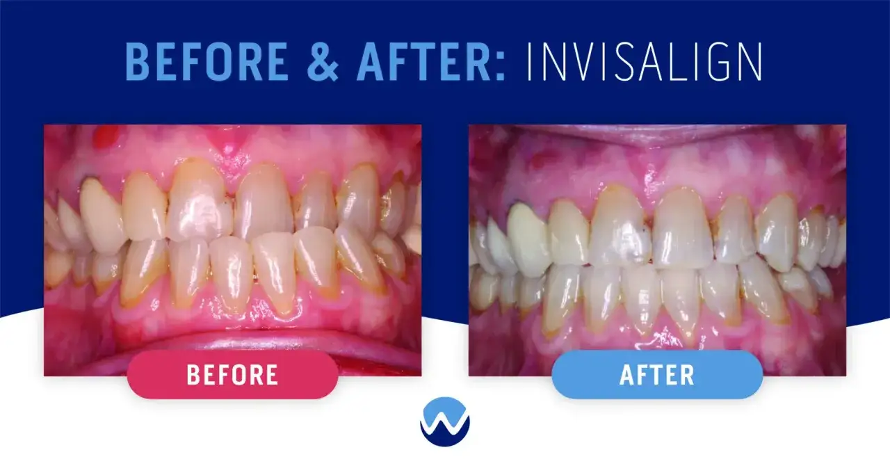 Przed i po: Invisalign co to? Zobacz metamorfozę uśmiechu dzięki niewidocznym nakładkom.
