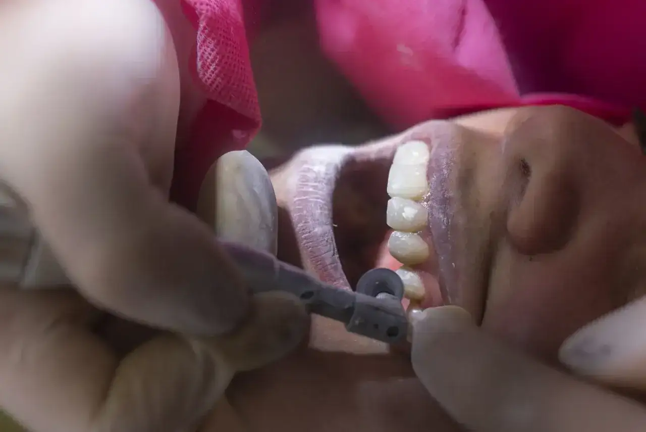 Dentysta usuwa resztki zęba w dziąśle po wyrwaniu, używając narzędzia.