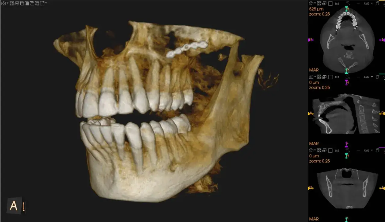 Trójwymiarowy pantogram szczęki i żuchwy z widocznymi implantami w górnej szczęce.