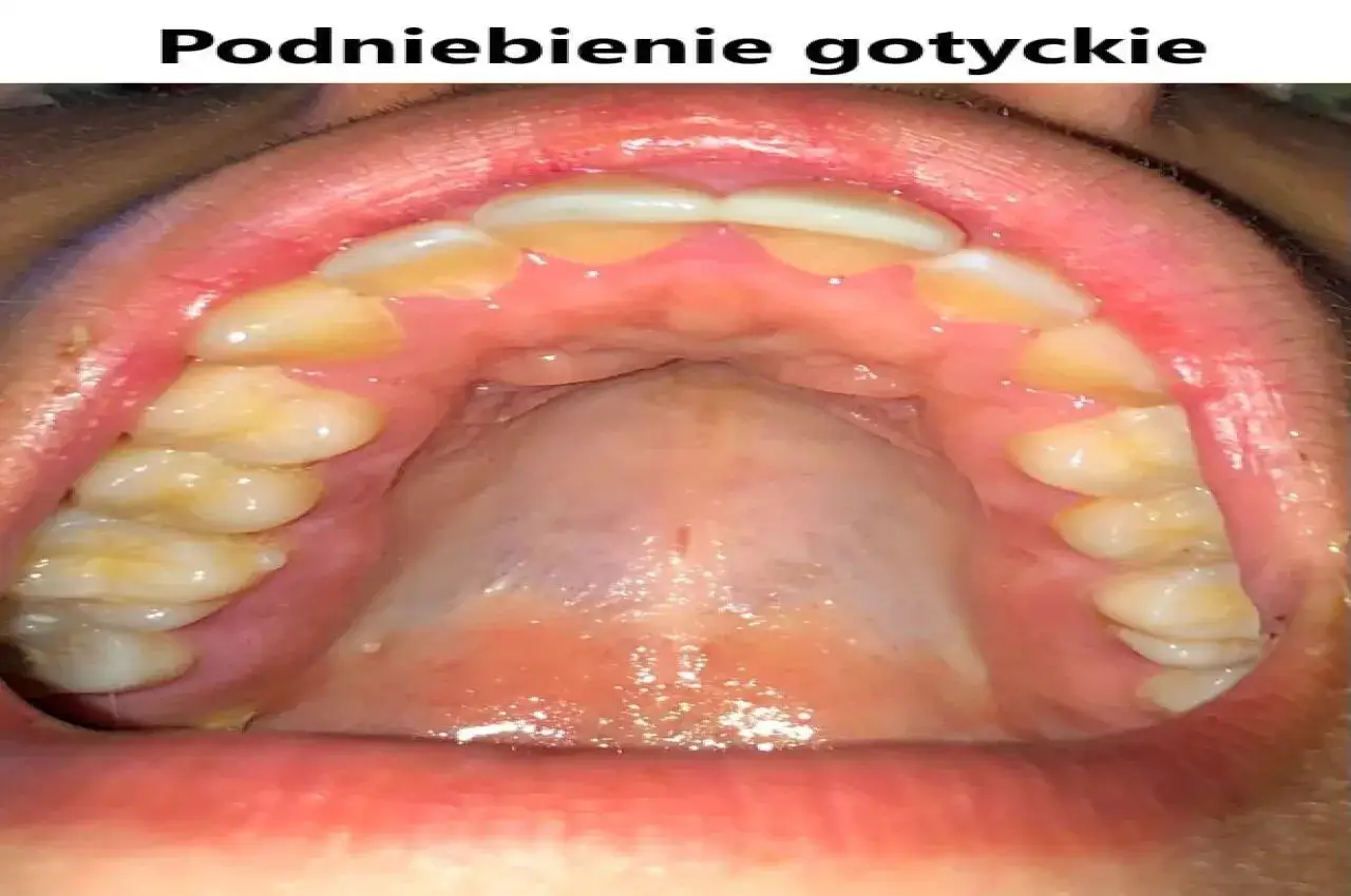 Widok jamy ustnej z zębami i podniebieniem. Charakterystyczne, wysokie podniebienie gotyckie, z widocznymi zębami trzonowymi i przedtrzonowymi.