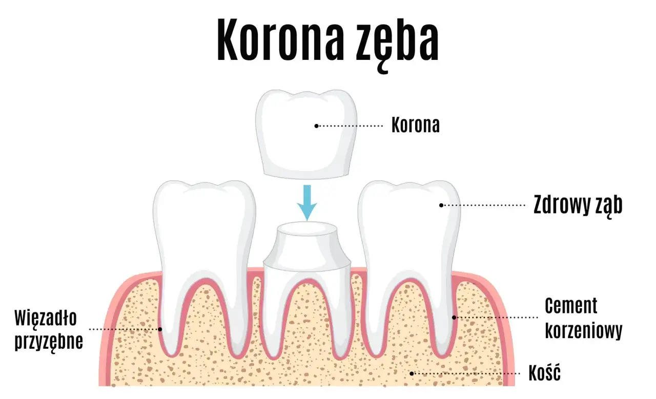 Ilustracja przedstawia proces zakładania korony zęba. Widoczne są zdrowe zęby, cement korzeniowy, kość i więzadło przyzębne.