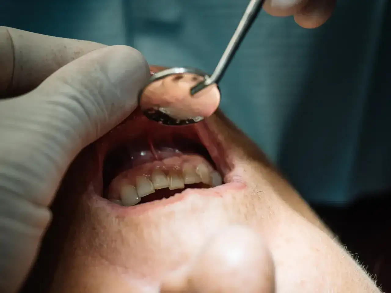 Dentysta bada usta pacjenta, który cierpi z powodu tragicznego bólu zęba.