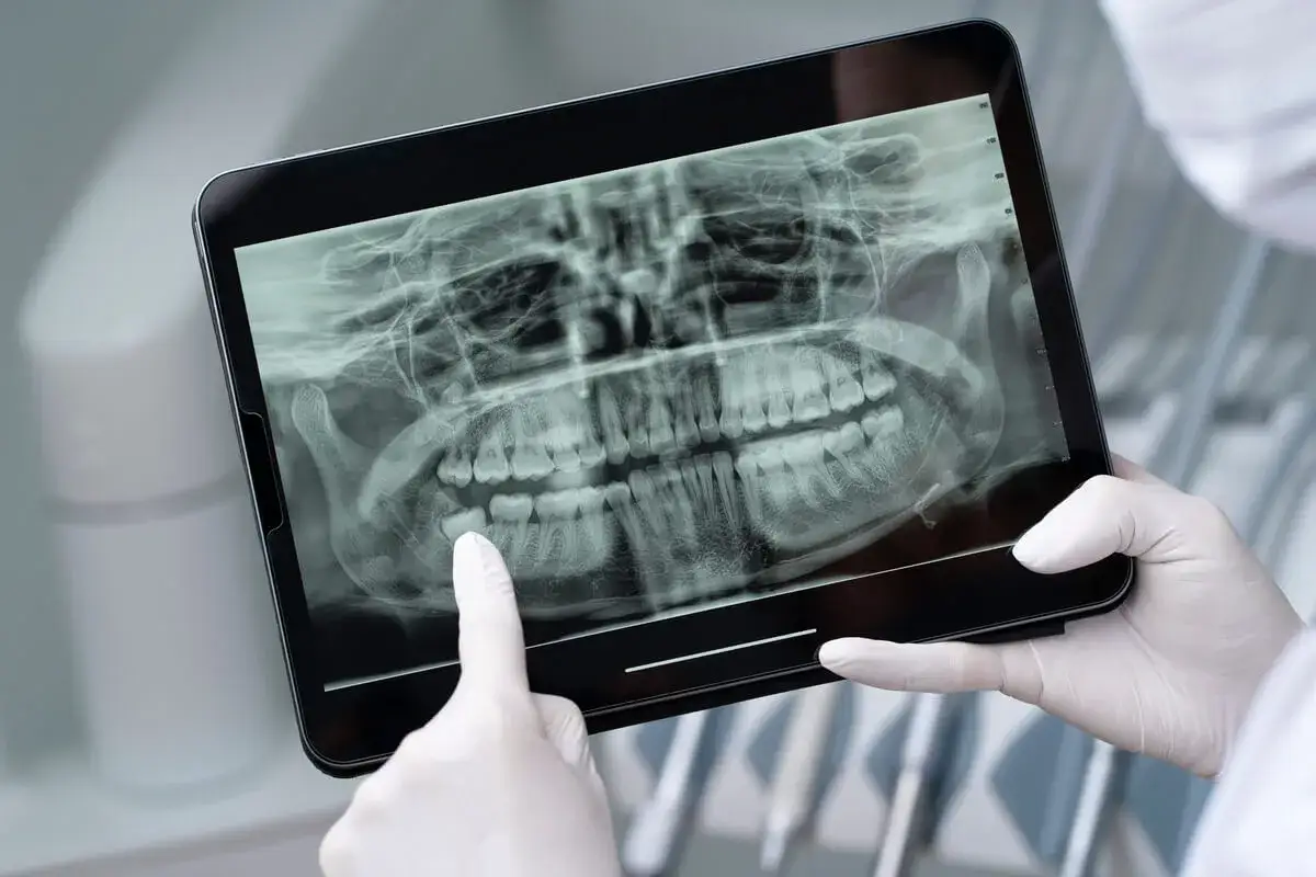Dentysta w rękawiczkach analizuje na tablecie zdjęcie pantomograficzne szczęki i żuchwy, wykonane metodą CBCT.