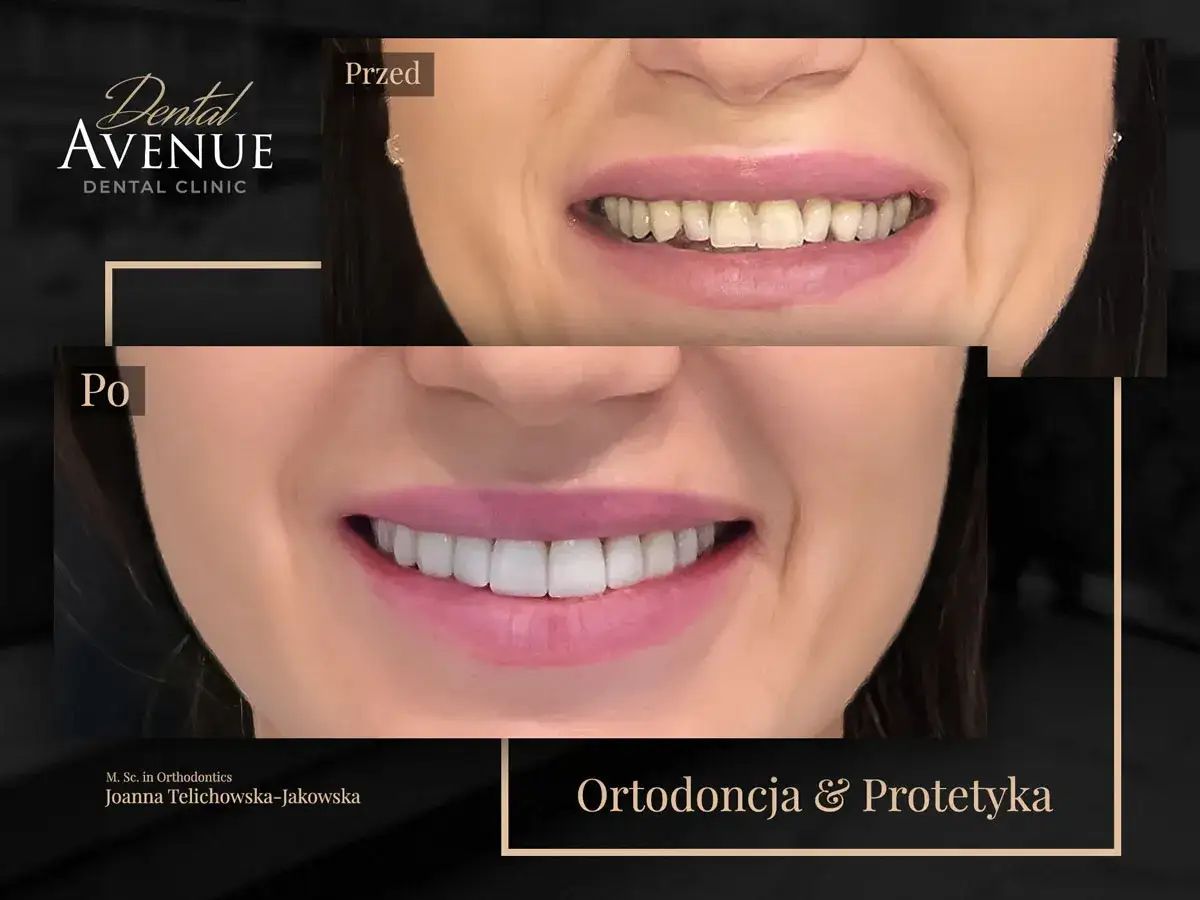 Przed i po: metamorfoza uśmiechu. Bonding wszystkich zębów cena – zapytaj o szczegóły w Dental Avenue.