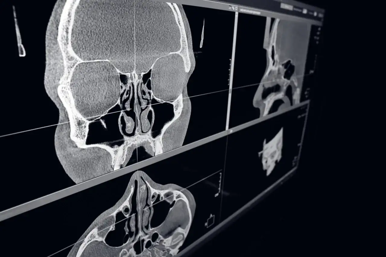 Tomografia komputerowa pozwala ocenić struktury nosa i zatok, co jest kluczowe w diagnostyce, czy tomografia komputerowa wykryje raka.